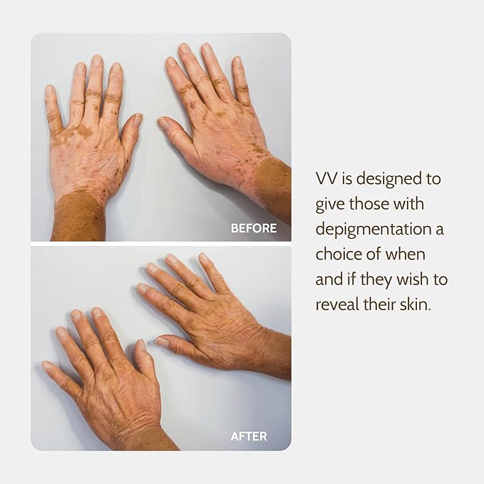 Vitiligo Vanquish Cosmetic Camouflage Kit by Fake Bake Liquid Concealer, Long Lasting Natural Color Customization Eliminates Appearance of Skin Depigmentation For Women & Men - Cover Lasts For Days