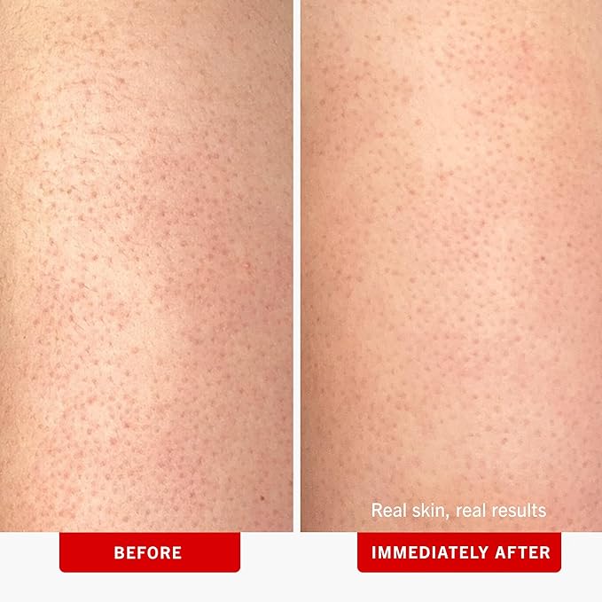 First Aid Beauty KP Bump Eraser Body Scrub Exfoliant for Keratosis Pilaris with 10% AHA – 8 oz + Bonus 1 oz Travel Size Tube