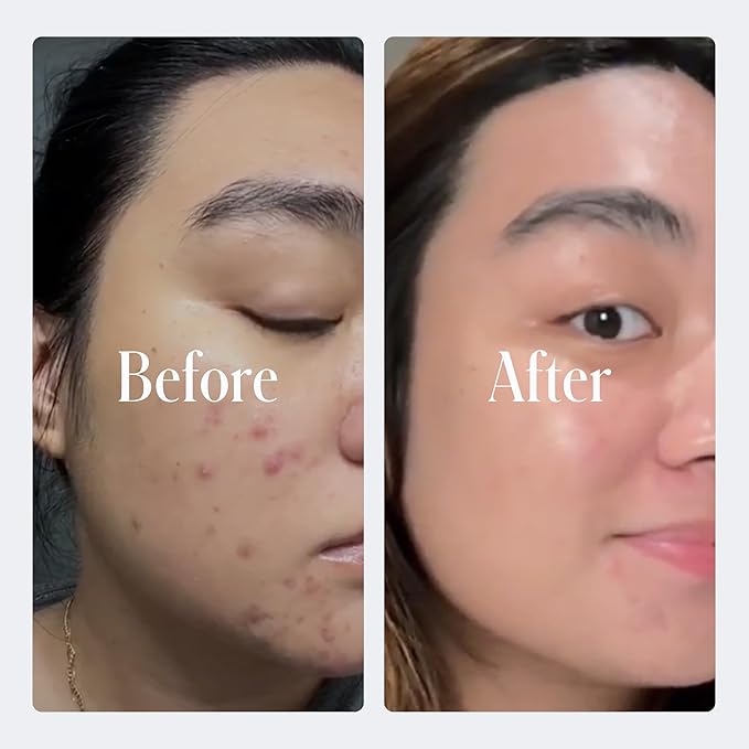 Geologie Clear System | 3-Step Acne Treatment & Skincare Set | Clears Skin Fast | Acne Gel Cleanser, SPF15 Day Cream & .3% Retinol Face Cream For Men & Women | Month 3+ / Level 3