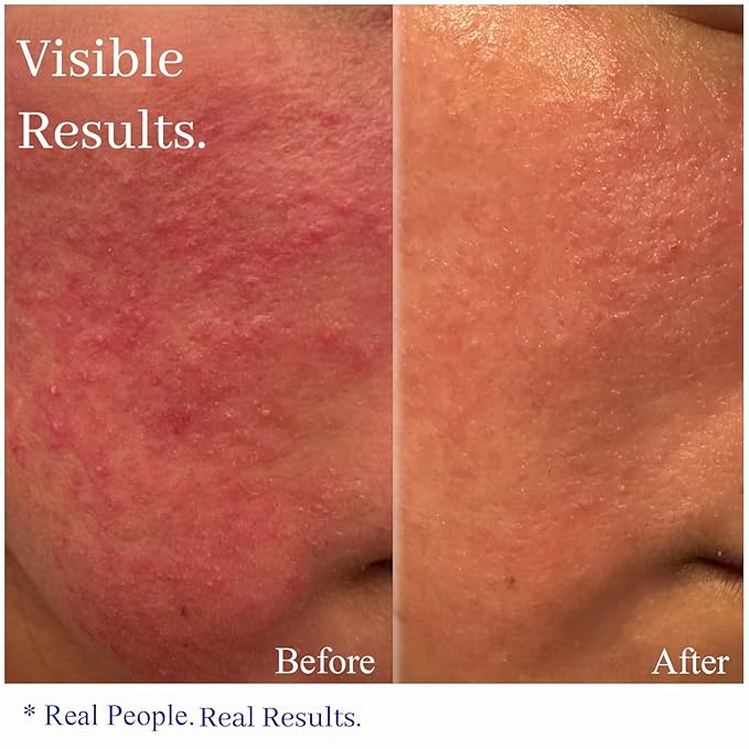 Hey Honey Skincare Relax, Instant Rosacea Treatment & Face Redness Relief - Dermatologically Tested Calming Moisturizer for Sensitive Skin Oil- Free with Honey & Propolis Anti-Aging Benefits | 2.2 Oz