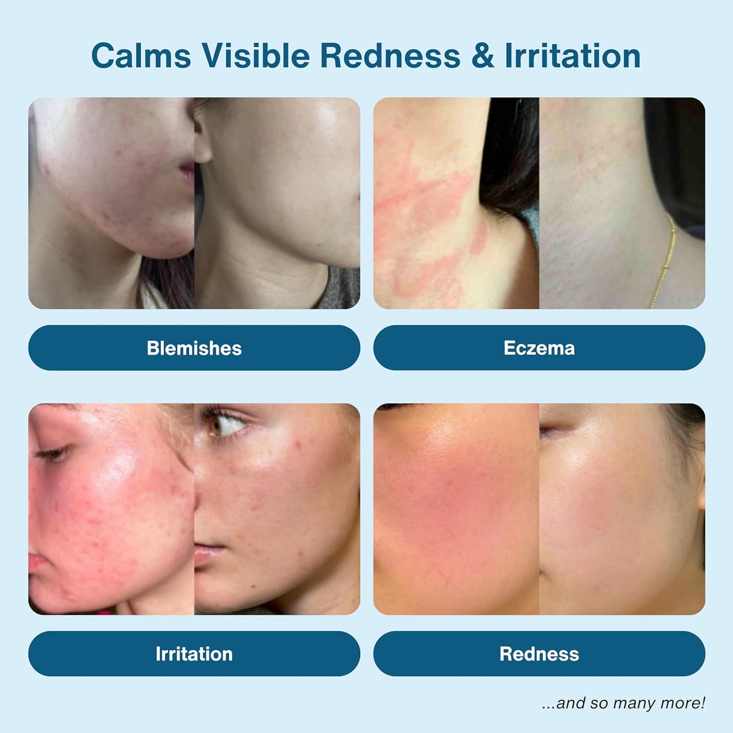 Hypochlorous Acid Spray - HOCL - Hypoallergenic Skin Toner Cleanse and Soothe Sensitive Face - Acne - Eczema - Bacne - Eyelid - Pre Post Workout (Mini Bundle Pack - 2fl + 2 fl)